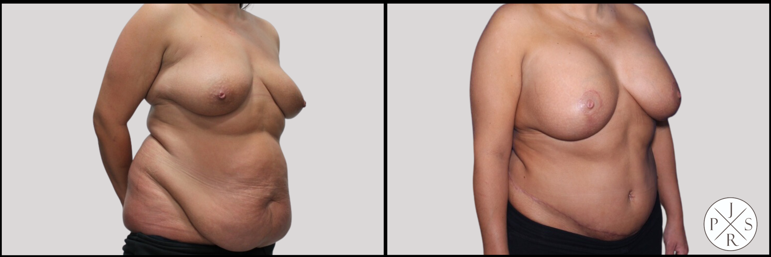 Abdominoplasty Before & After Image